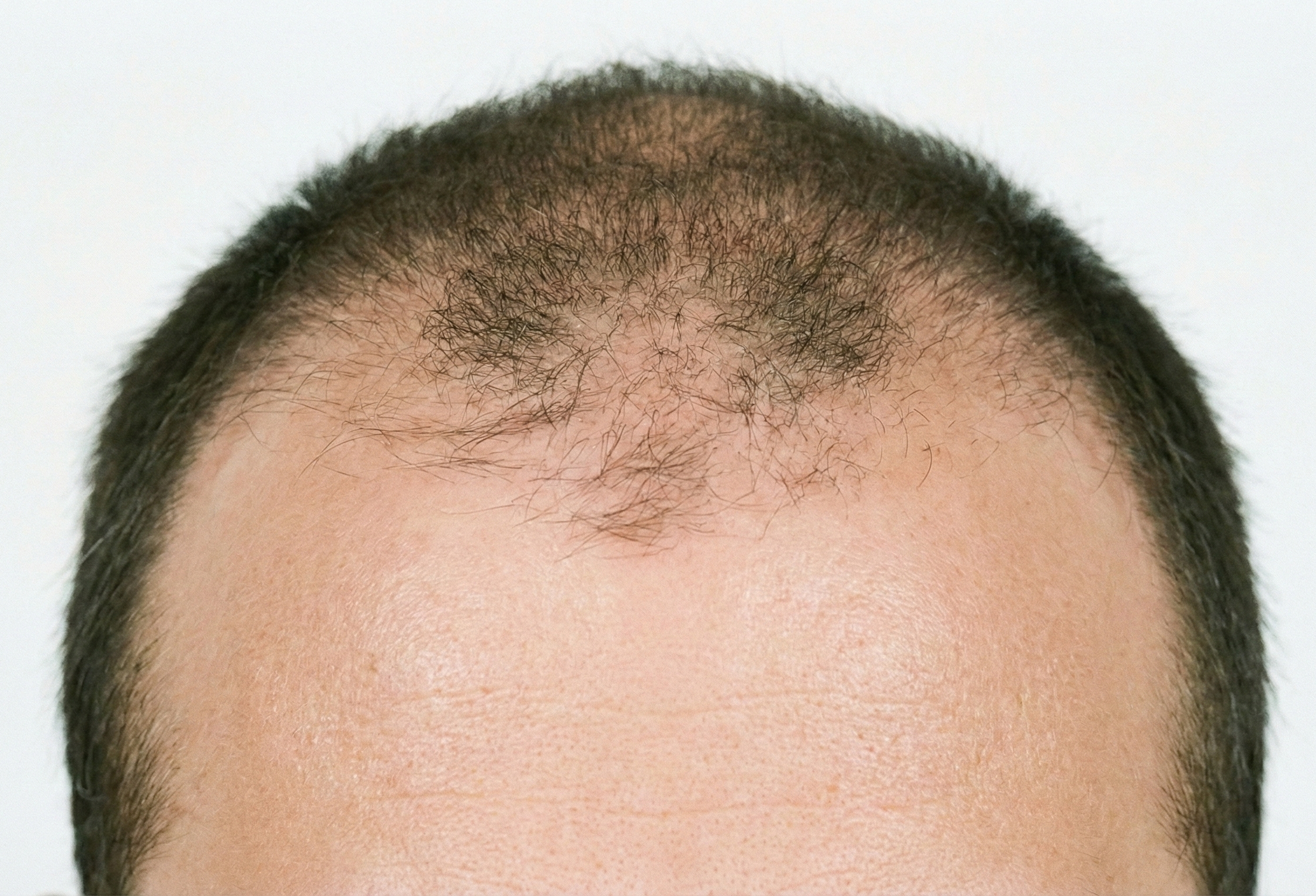 Antes do tratamento para alopecia
